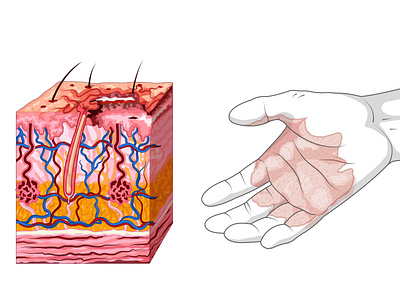 Quemadura de primer grado accidente dermis epidermis fuego hipodermis ilustración didáctica krotalon primeros auxilios quemaura