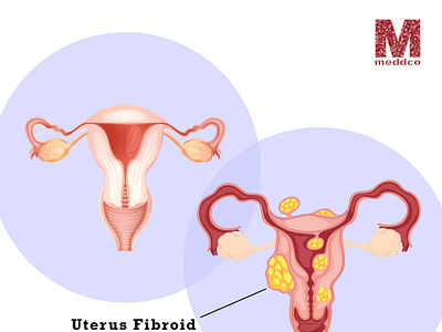uterus fibroid entdoctor entspecialist