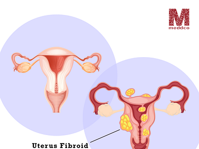 uterus fibroid