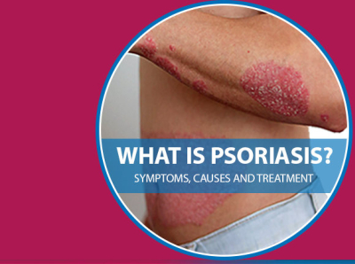 Psoriasis : Symptoms, Causes and Treatment by vps on Dribbble