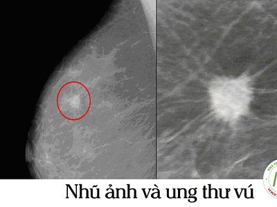 [Tìm hiểu bênh] Nhũ ảnh và ung thư Vú cancer