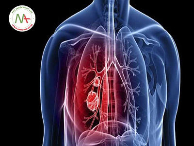 Tăng áp phổi mạn do huyết tắc: Can thiệp ngoại khoa bệnh
