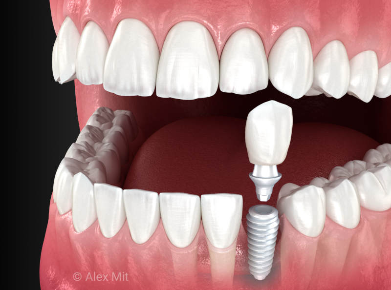 Dental Implant, abutment and ceramic crown, 3D illustration by Alex Mit ...