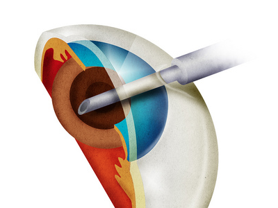 Eye Surgery Illustration