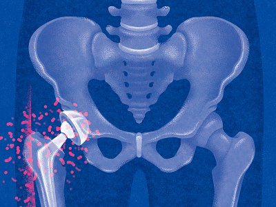 Prosthetic Joint Infection digital editorial folioart illustration kouzousakai medical science texture xray