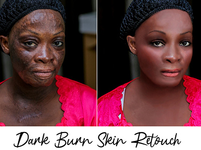 Dark Burn Skin Retouch