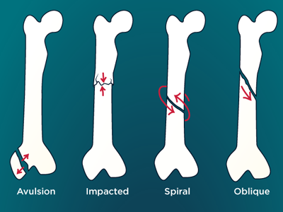 Bone Fractures Guide blog blue bone break health illustration illustrator informative orthopedics vector visual guide wellness
