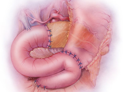 Whipple procedure illustration medical surgery