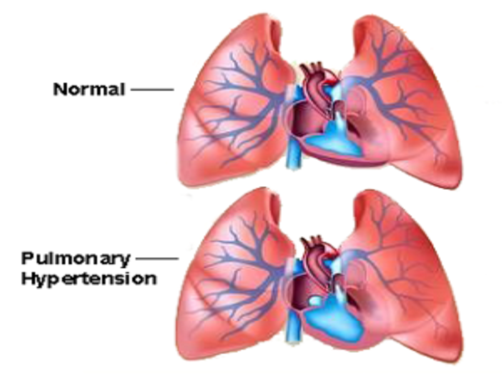 what-is-pulmonary-arterial-hypertension-by-mon-blogs-on-dribbble