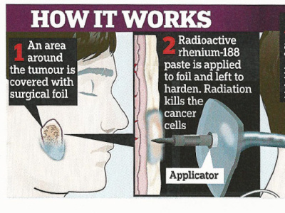 New cancer treatment infographic for Daily Mail Newspaper