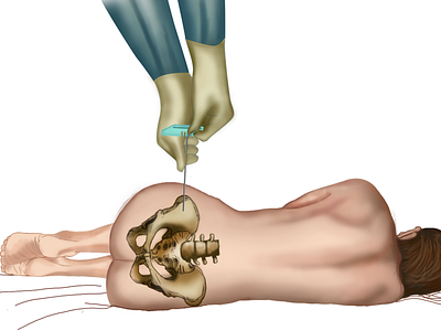 Bone biopsy digital illustration illustration scientific illustration