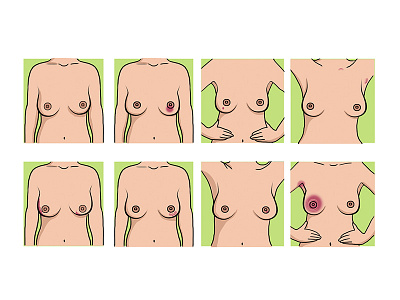 Medical Illustrations - Breast Cancer art health healthcare illustrations medical