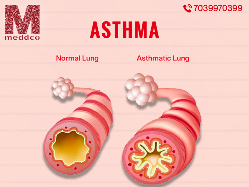 Asthma treatment by meddco on Dribbble