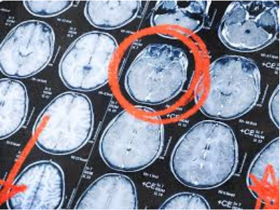 What foods should you avoid if you have Parkinson's disease? parkinson radiology rehabilitation symptoms treatment