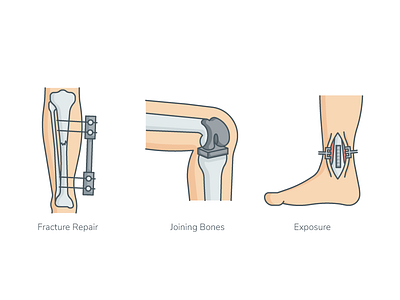 Surgery Icons access exposure fracture joining bones medical operation repair support surgeon