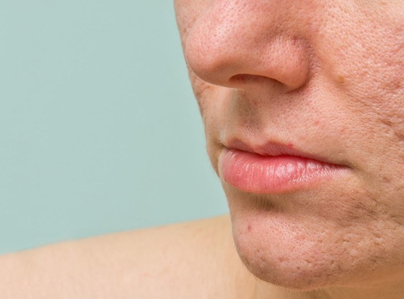 Acne Scars Treatment in Jaipur by Abhishek Hospital on Dribbble