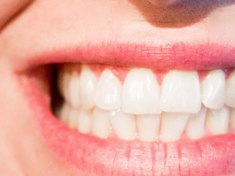 veneers in abu dhabi by Royal Dental on Dribbble