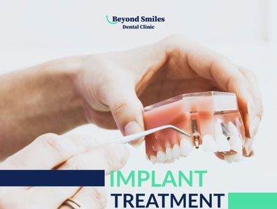 How much do dental implants cost in Banglore?