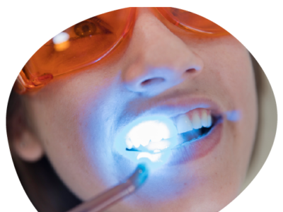Dental laser treatment near Koramangala | Beyond Smiles by Beyond Smile on Dribbble