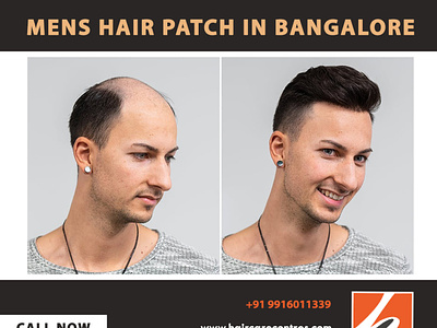 Best hair patch in bangalore