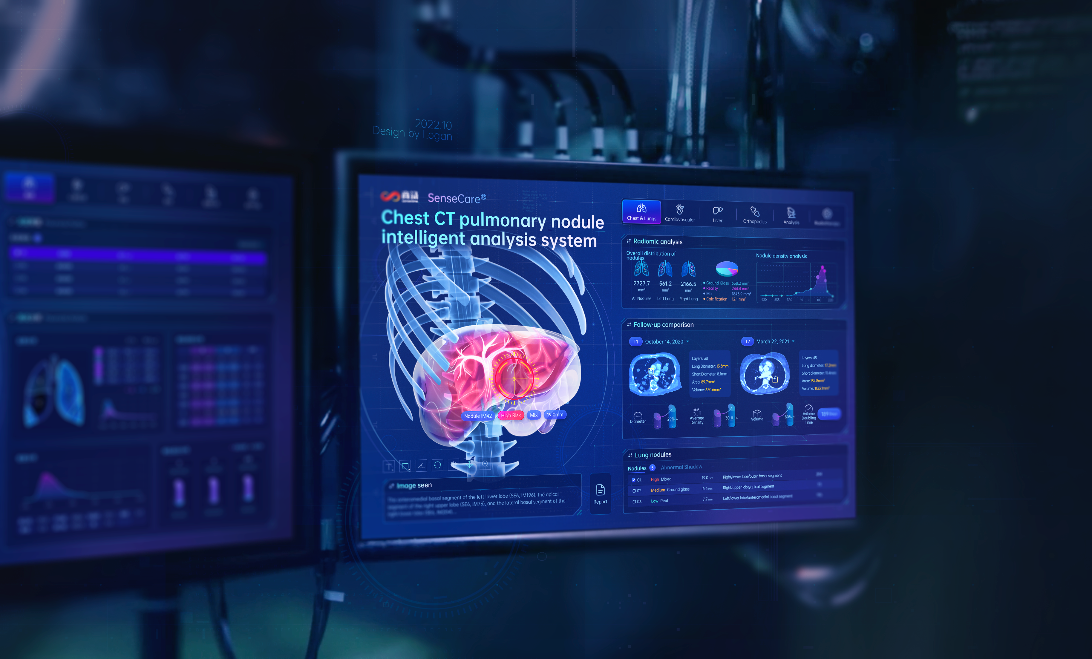 Sensetime-Chest CT pulmonary nodule intelligent analysis system hud
