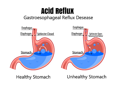 The human stomach is full of stomach acid diagnosis