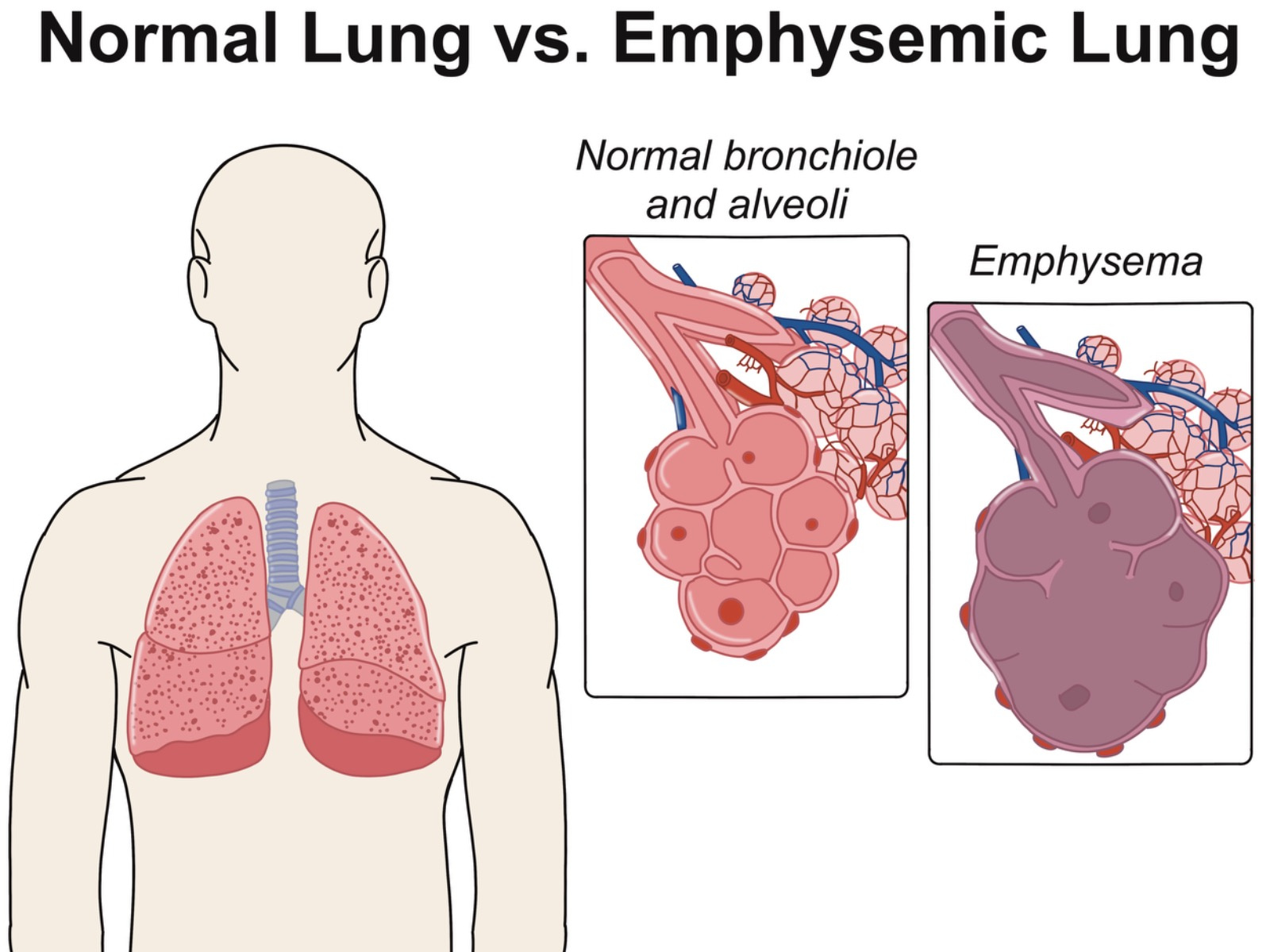 emphysema lung vs normal lung