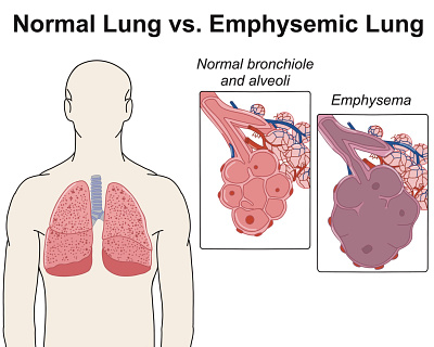 Lungs Pathology adobe illustrator anatomy biology graphic design lungs pathology medical illustration science illustration
