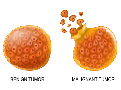 Cancer cells in Benign neoplasm and Malignant tumors anatomy cancer cell education illustration medical metastasis poster science tumor