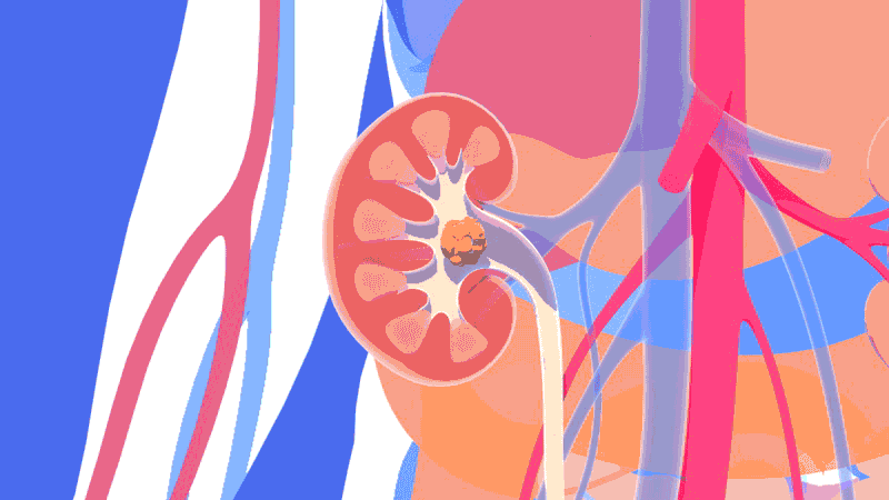 Kidney stone treatment animation 3d 3d art anatomy design illustration kidney stone medical treatment