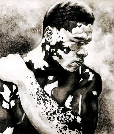 Vitiligo illustration sketch vitiligo