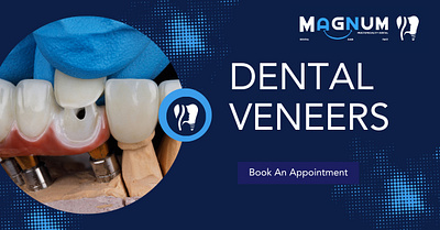 What Are Dental Veneers And Its Benefits - Magnum Dental bestdentalclinicnearme bestdentalhospitalnearme bestdentistnearme dentalclinicinmanikonda dentalclinicnearme dentalhospitalnearme dentistnearme