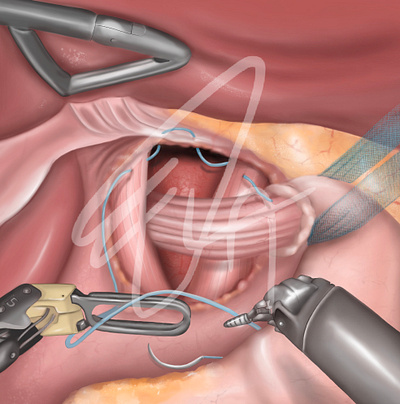 Surgery (Hiatus hernia) anatomy digitalillustration illustration instruction medical medicine operation surgery