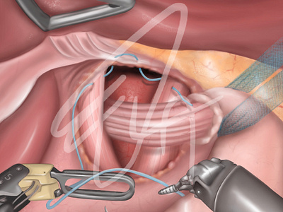 Surgery (Hiatus hernia) anatomy digitalillustration illustration instruction medical medicine operation surgery