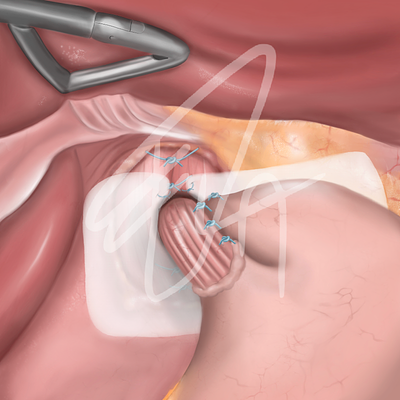 Surgery (Hiatus hernia) - Medical illustration anatomy digitalillustration illustration medical medicine operation surgery technique