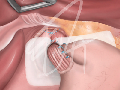 Surgery (Hiatus hernia) - Medical illustration anatomy digitalillustration illustration medical medicine operation surgery technique