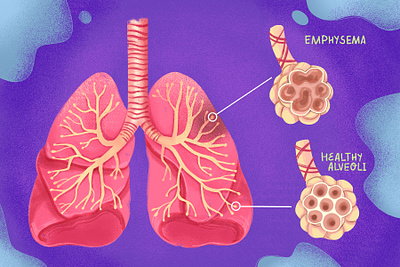 Emphysema Illustration biological design disease health illustration lungs medical medical illustration medicine procreate