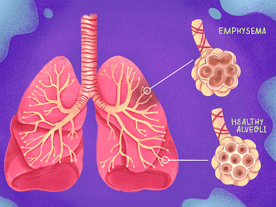 Emphysema Illustration biological design disease health illustration lungs medical medical illustration medicine procreate