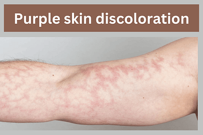 Purple Skin Discoloration: What You Need to Know purple skin discoloration