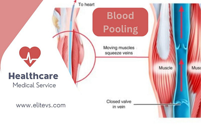 What is Blood Pooling and How to Avoid It blood pooling