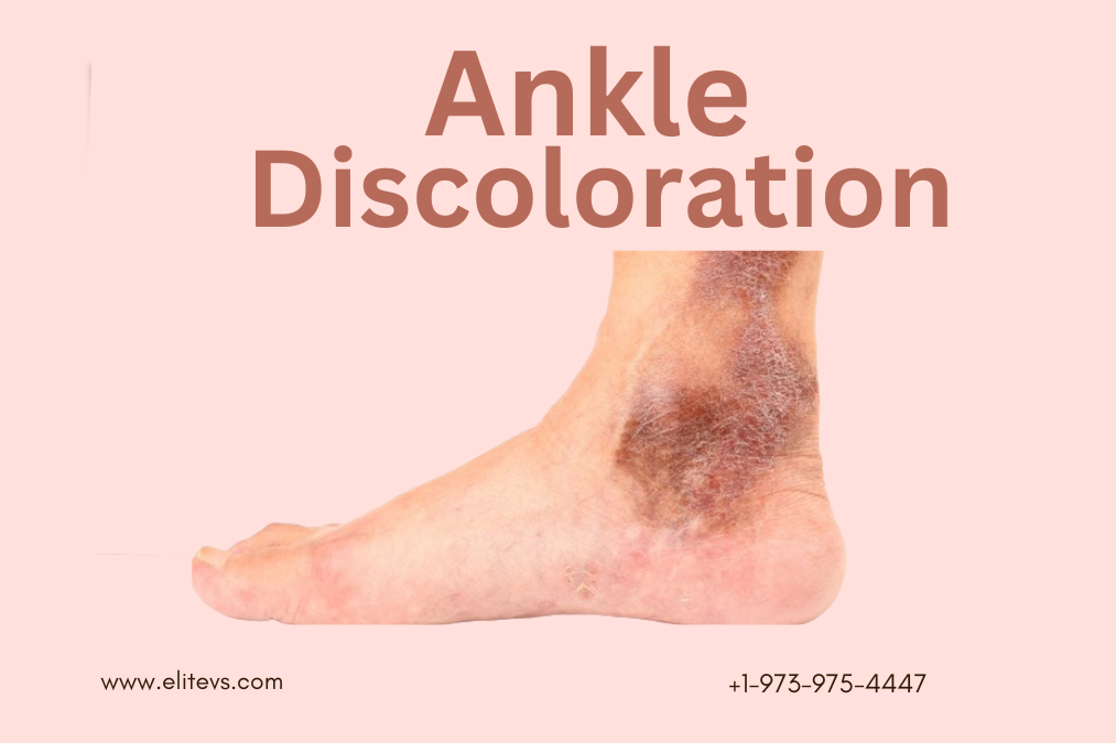 The Magic of Ankle Discoloration: A Guide to Radiant Skin by Amelia ...