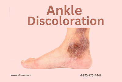 The Magic of Ankle Discoloration: A Guide to Radiant Skin ankle discoloration veins health