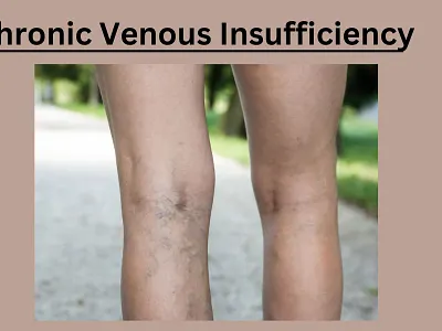 Venous Insufficiency Medical Procedures: What You Need to Know venous insufficiency