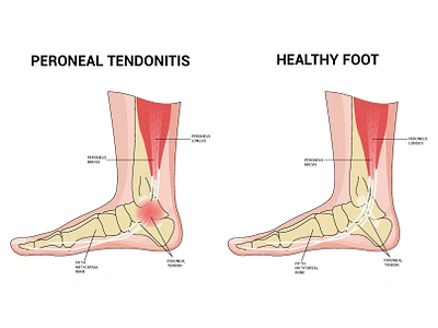 PERONEAL TENDONITIS Vector Illustration. anatomy illustration branding diagrams exercises figures graphic design logo peroneal tendonitis vector illustration