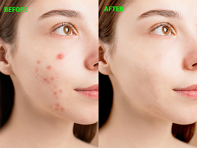 Photo Editing(acne face) adobe photoshop background removal graphic design photo editing photoshop manipulation skin retouching