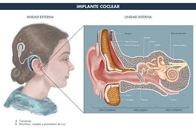 Cochlear implant illustration scientific illustration
