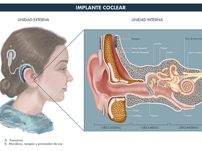 Cochlear implant illustration scientific illustration