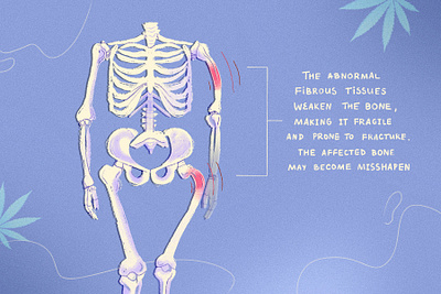 Biomedical Illustration biomedical design disorder drawing fibrous graphic design health human illustration medical illustration medicine modern skeleton