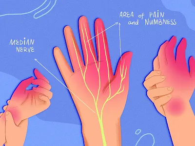 Carpal Tunnel Syndrome ache biomedical biomedical illustration carpal tunnel design disorder hands health hospital illustration medical medicine nerve pain syndrome wrist