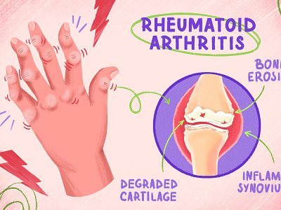 Rheumatoid Arthritis arthritis autoimmune biomedical biomedical illustration bone cartilage design disorder drawing hands health illustration inflammation joints medical pain procreate